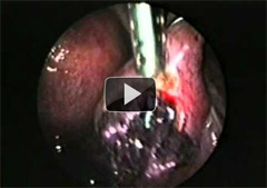 Ectopic pregnancy on both oviducts. Salpingotomy, removal of fetus and retaining of the oviducts. 